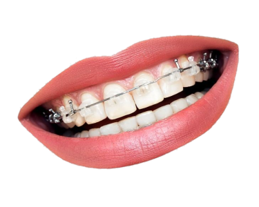 Teeth with Metal Braces Clipart